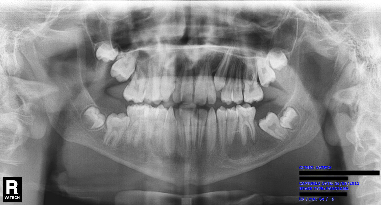xray-1